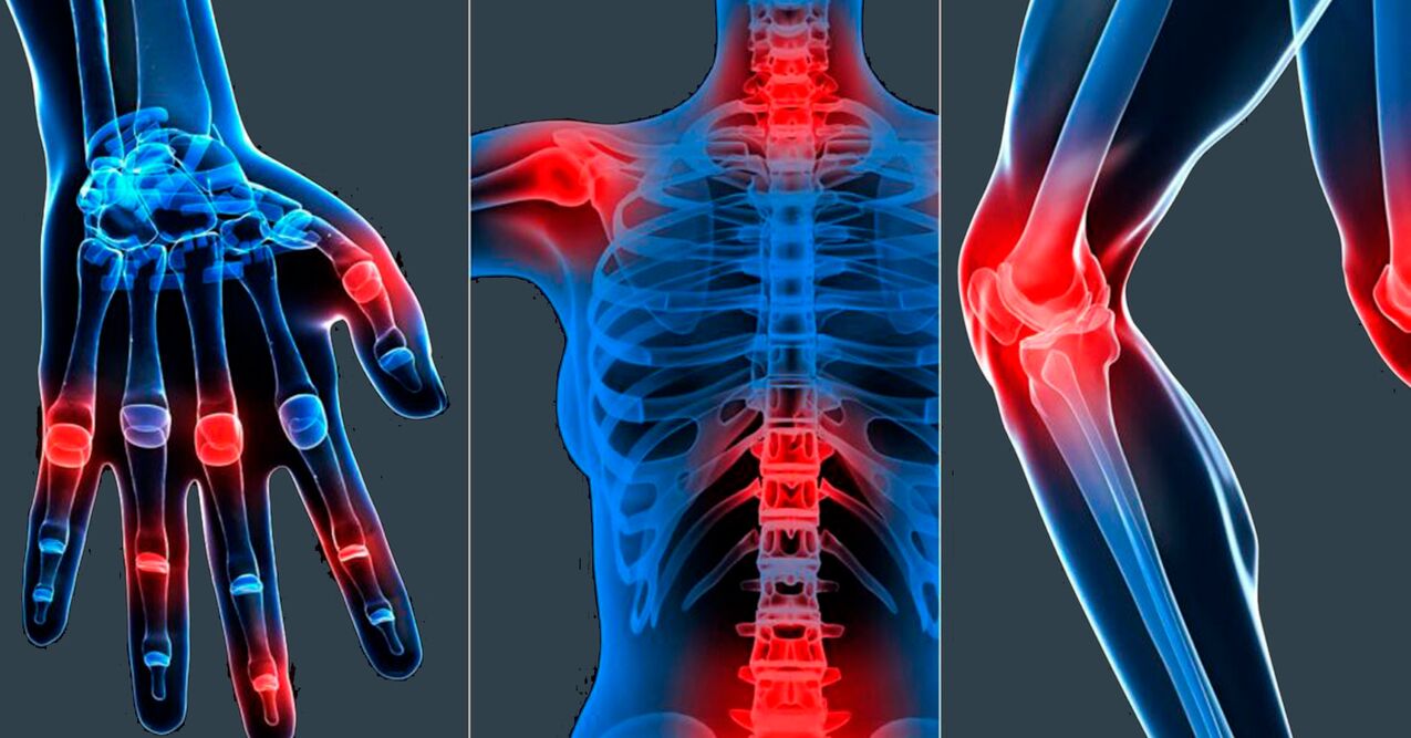 Indikacije za uporabo izvlečka bosvelije v kapsulah