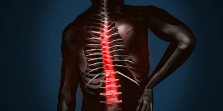 poškodbe hrbtenice zaradi osteohondroze